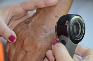 O câncer da pele responde por 33% de todos os diagnósticos desta doença no Brasil